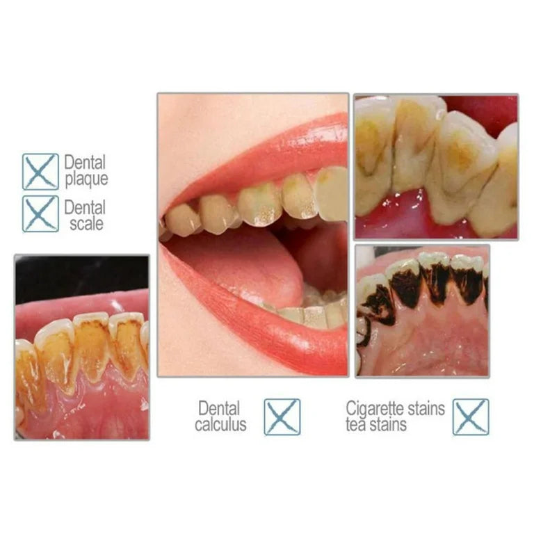 🦷✨ Limpiador Dental Ultrasónico con Cepillo y Carga USB – ¡Sonríe sin sarro!